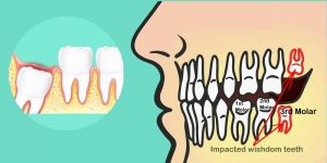 Can Wisdom Teeth Grow Back