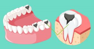 Home Remedies for Abscess Tooth